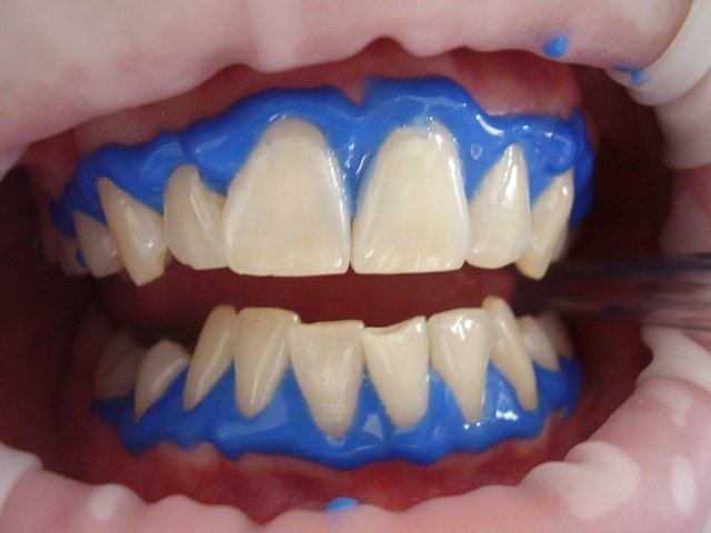 dont be afraid to smile anymore try these whitening of the teeth tips